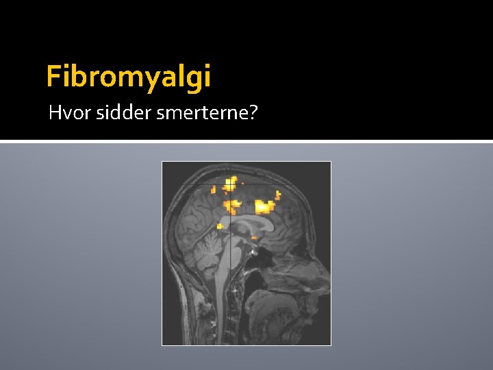 Fibromyalgi Hvor sidder smerterne? 