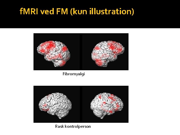 f. MRI ved FM (kun illustration) Fibromyalgi Rask kontrolperson 