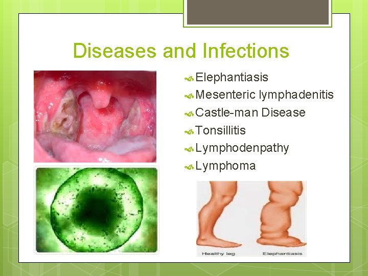 Diseases and Infections Elephantiasis Mesenteric lymphadenitis Castle-man Disease Tonsillitis Lymphodenpathy Lymphoma 