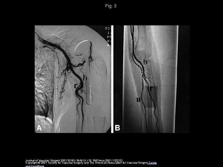 Fig. 3 Journal of Vascular Surgery 2001 33191 -194 DOI: (10. 1067/mva. 2001. 112212)