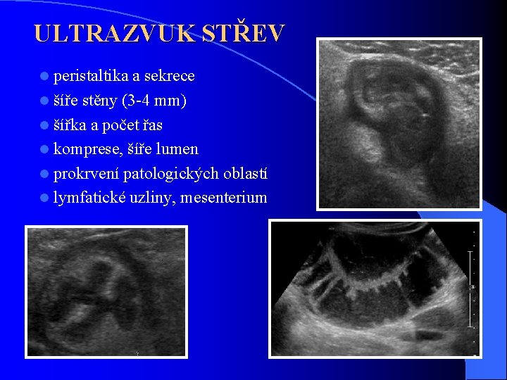 ULTRAZVUK STŘEV peristaltika a sekrece l šíře stěny (3 -4 mm) l šířka a