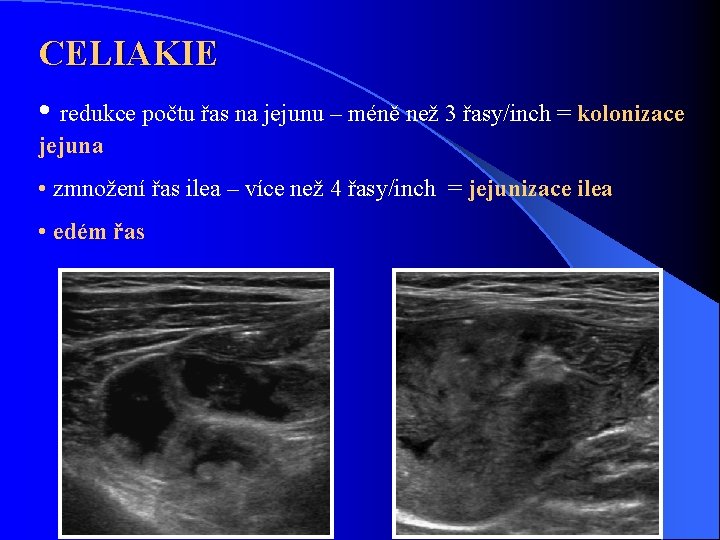 CELIAKIE • redukce počtu řas na jejunu – méně než 3 řasy/inch = kolonizace