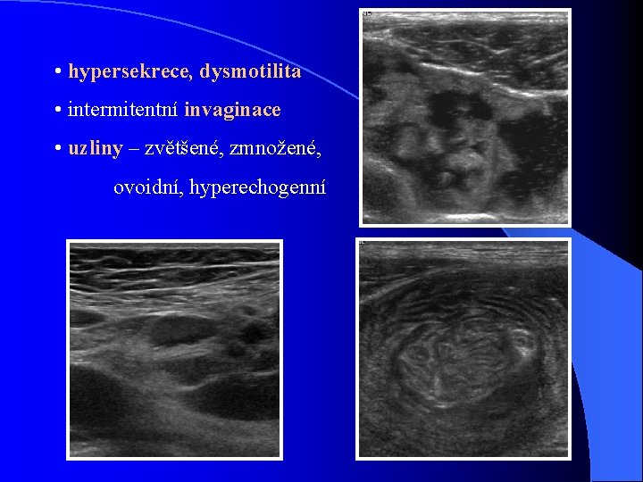  • hypersekrece, dysmotilita • intermitentní invaginace • uzliny – zvětšené, zmnožené, ovoidní, hyperechogenní