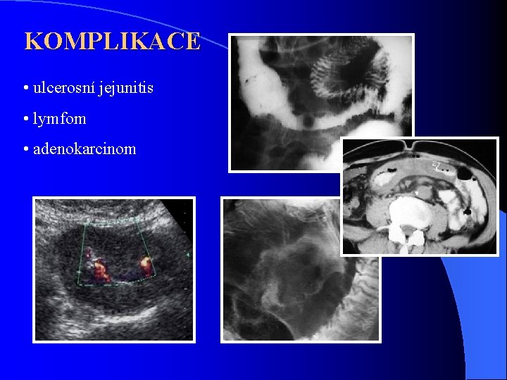 KOMPLIKACE • ulcerosní jejunitis • lymfom • adenokarcinom 