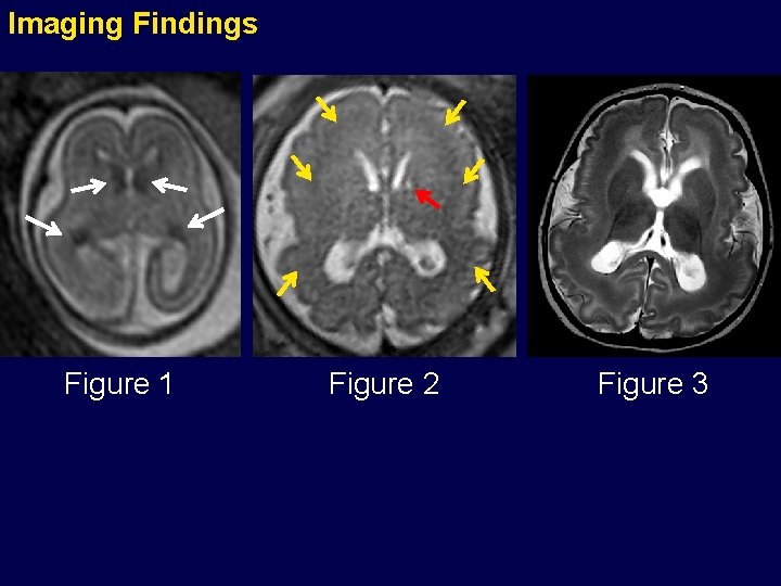 Imaging Findings Figure 1 Figure 2 Figure 3 