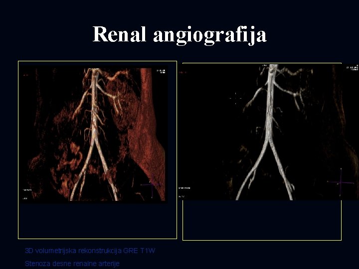 Renal angiografija 3 D volumetrijska rekonstrukcija GRE T 1 W Stenoza desne renalne arterije