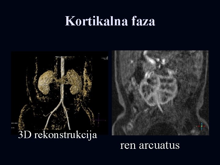 Kortikalna faza 3 D rekonstrukcija ren arcuatus 