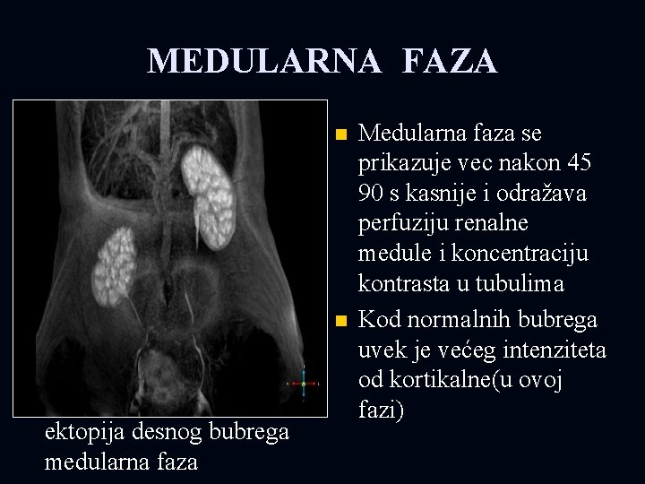 MEDULARNA FAZA n n ektopija desnog bubrega medularna faza Medularna faza se prikazuje vec