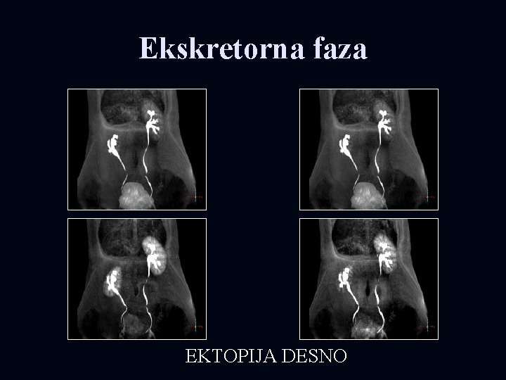 Ekskretorna faza EKTOPIJA DESNO 