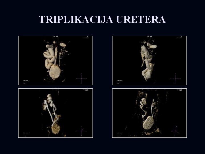 TRIPLIKACIJA URETERA 