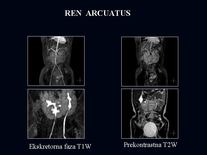  REN ARCUATUS Ekskretorna faza T 1 W Prekontrastna T 2 W 