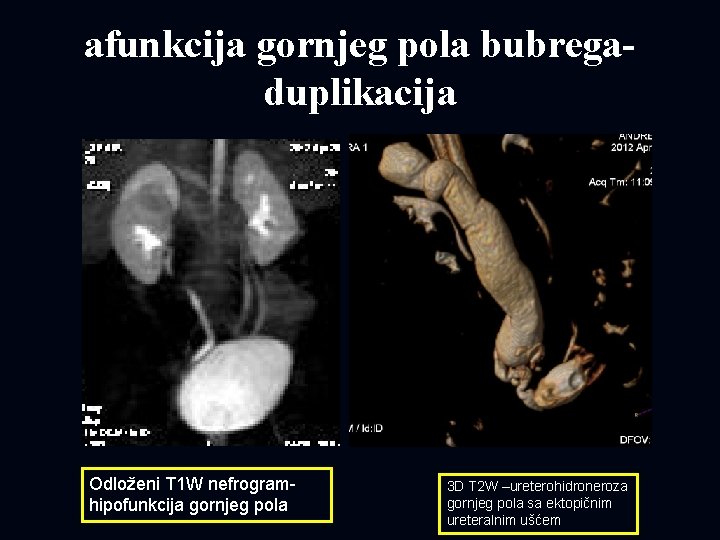 afunkcija gornjeg pola bubregaduplikacija Odloženi T 1 W nefrogramhipofunkcija gornjeg pola 3 D T