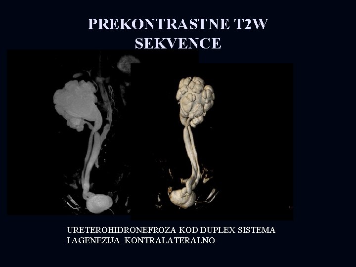 PREKONTRASTNE T 2 W SEKVENCE URETEROHIDRONEFROZA KOD DUPLEX SISTEMA I AGENEZIJA KONTRALATERALNO 