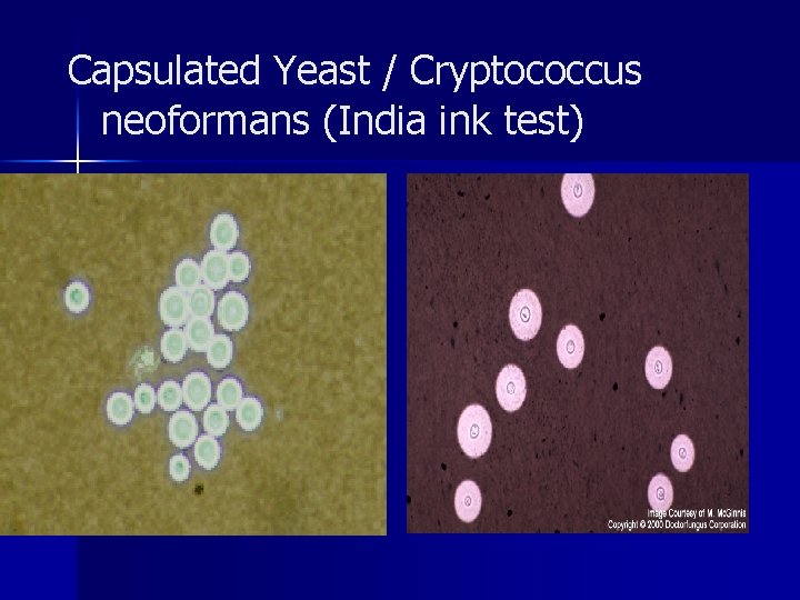 Capsulated Yeast / Cryptococcus neoformans (India ink test) 