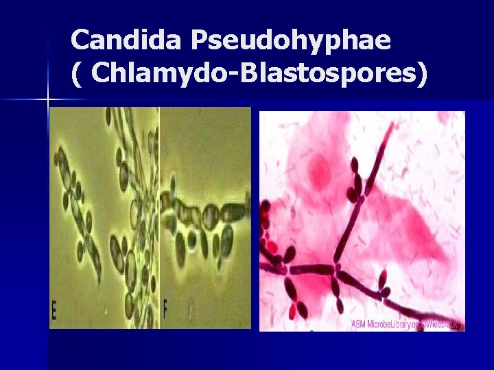 Candida Pseudohyphae ( Chlamydo-Blastospores) 