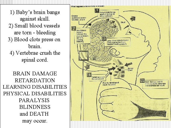 1) Baby’s brain bangs against skull. 2) Small blood vessels are torn - bleeding