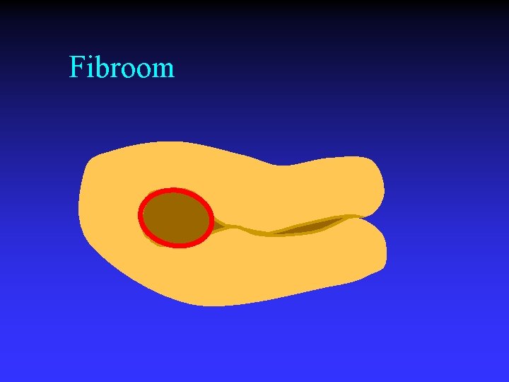 Fibroom 
