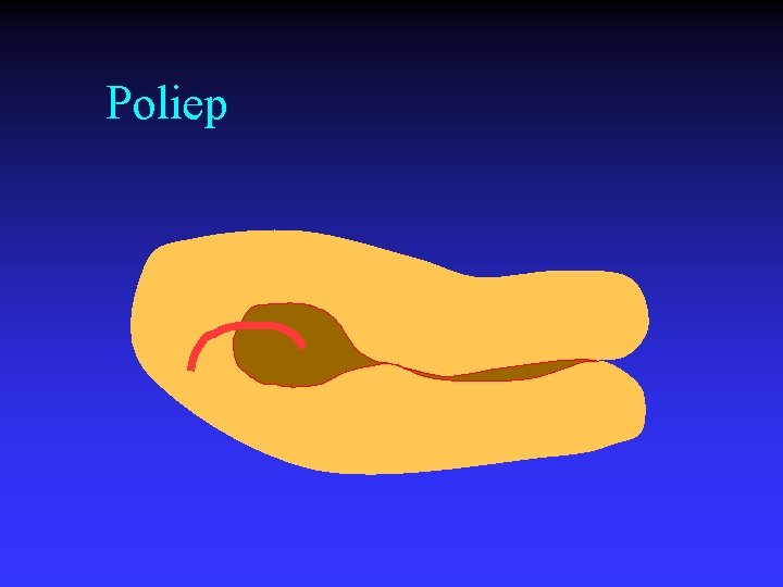 Poliep 