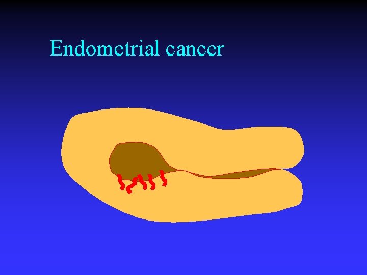 Endometrial cancer 