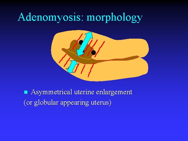 Adenomyosis: morphology Asymmetrical uterine enlargement (or globular appearing uterus) n 