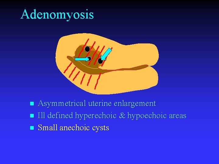 Adenomyosis n n n Asymmetrical uterine enlargement Ill defined hyperechoic & hypoechoic areas Small