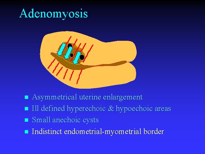 Adenomyosis n n Asymmetrical uterine enlargement Ill defined hyperechoic & hypoechoic areas Small anechoic