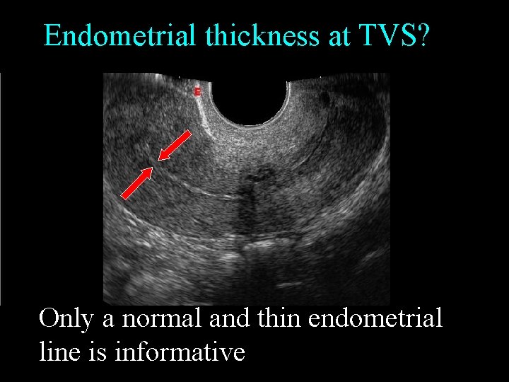 Endometrial thickness at TVS? Only a normal and thin endometrial line is informative 