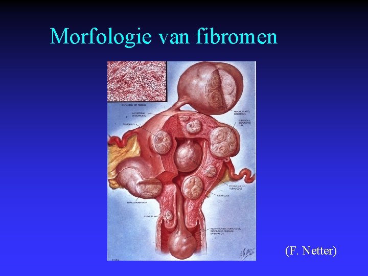 Morfologie van fibromen (F. Netter) 