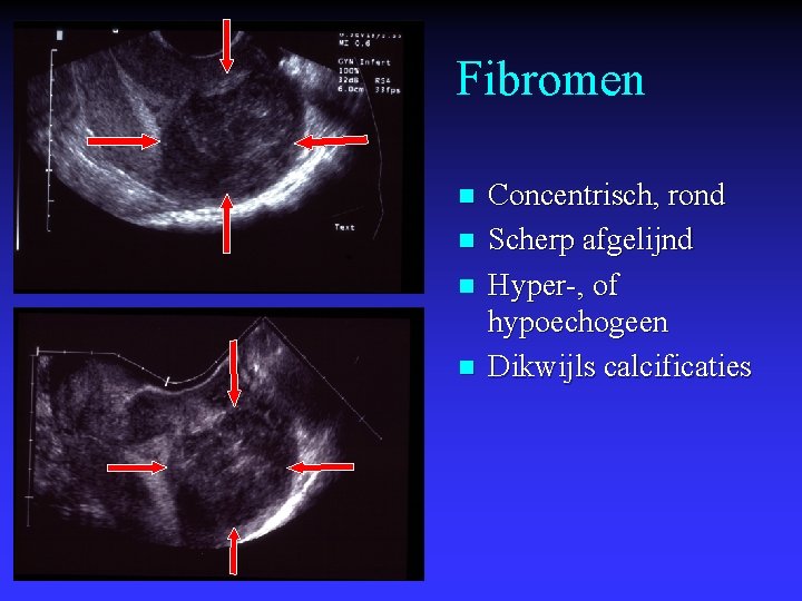 Fibromen n n Concentrisch, rond Scherp afgelijnd Hyper-, of hypoechogeen Dikwijls calcificaties 