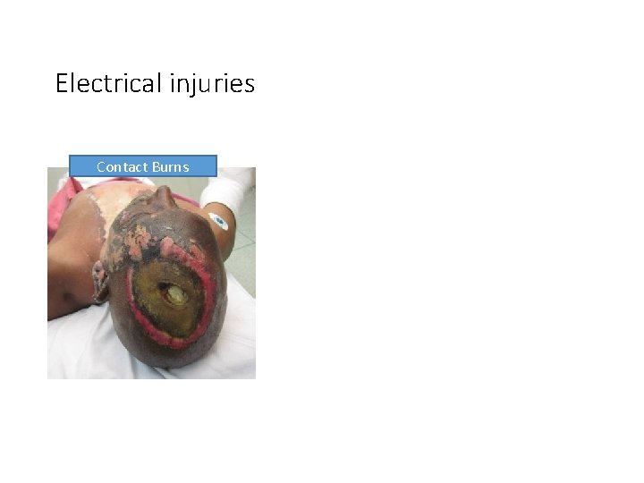 Electrical injuries Contact Burns 