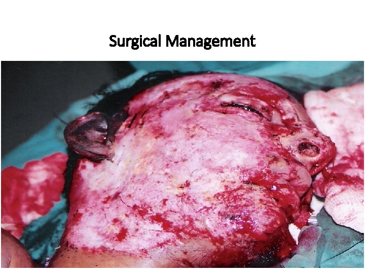 Surgical Management 