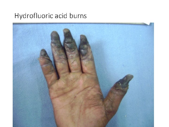 Hydrofluoric acid burns 
