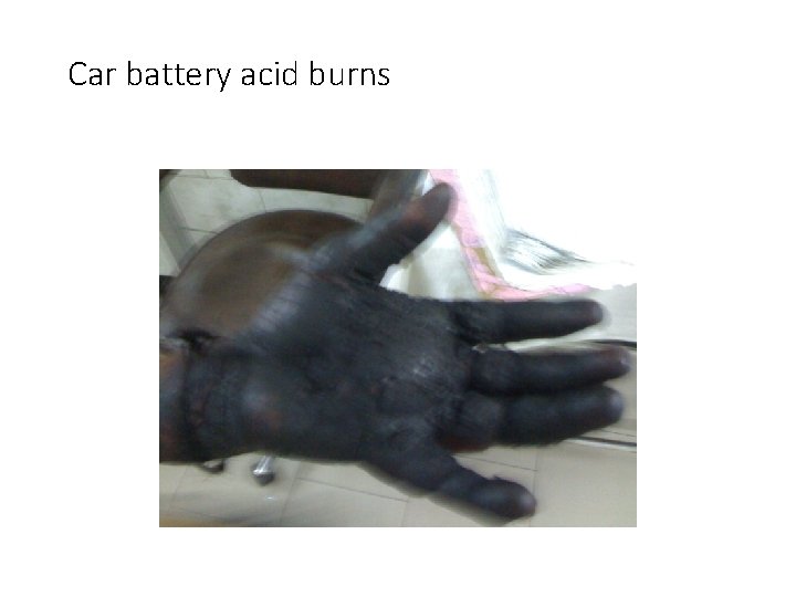 Car battery acid burns 