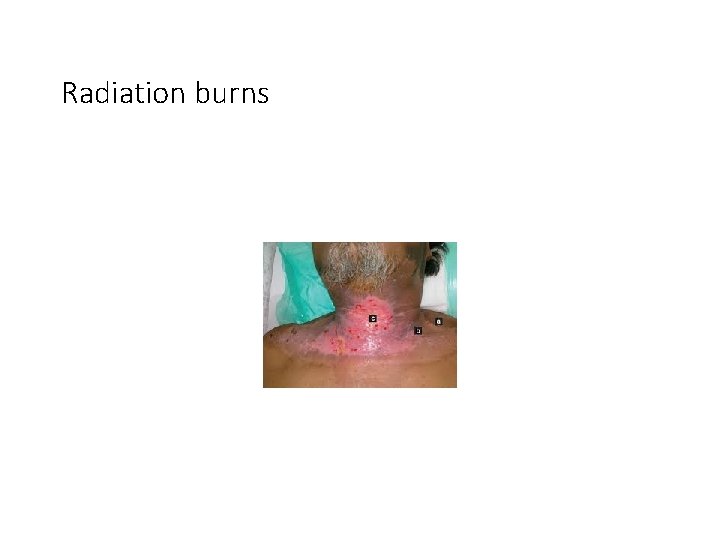 Radiation burns 