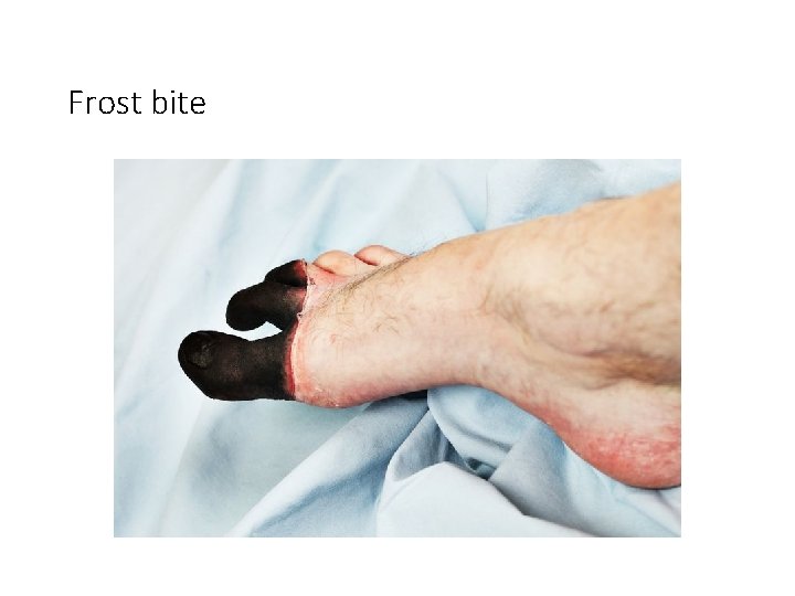 Frost bite 