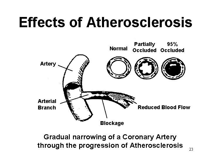 Effects of Atherosclerosis Partially 95% Normal Occluded Artery Arterial Branch Reduced Blood Flow Blockage