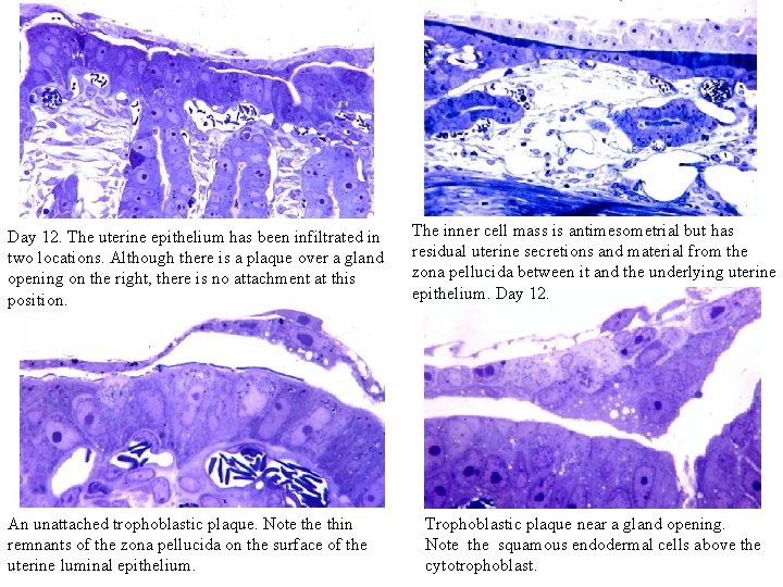 Day 12. The uterine epithelium has been infiltrated in two locations. Although there is