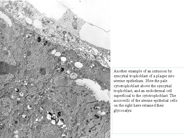 Another example of an intrusion by syncytial trophoblast of a plaque into uterine epithelium.