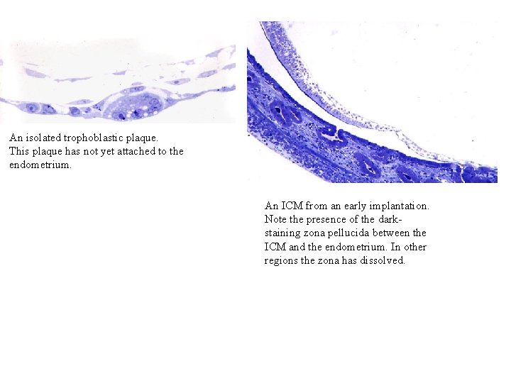 An isolated trophoblastic plaque. This plaque has not yet attached to the endometrium. An