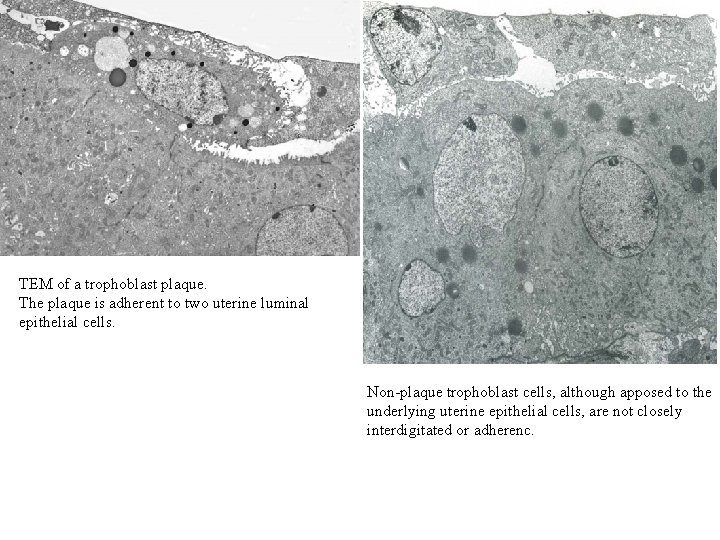 TEM of a trophoblast plaque. The plaque is adherent to two uterine luminal epithelial