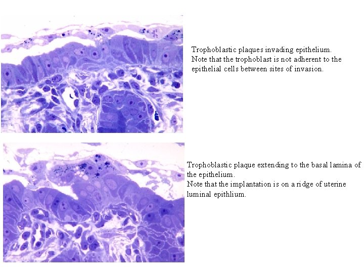 Trophoblastic plaques invading epithelium. Note that the trophoblast is not adherent to the epithelial
