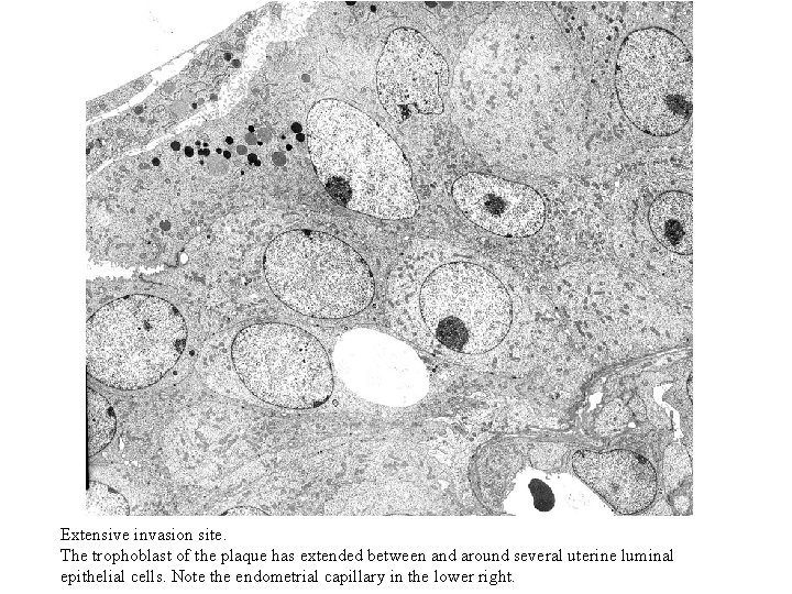 Extensive invasion site. The trophoblast of the plaque has extended between and around several