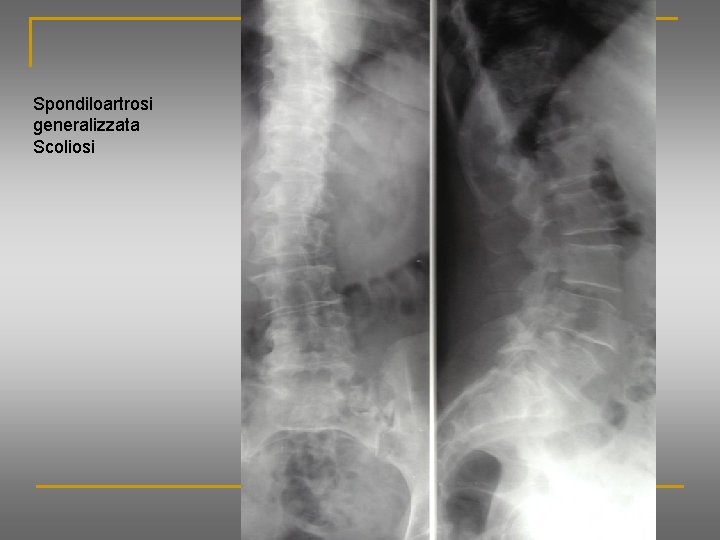 Spondiloartrosi generalizzata Scoliosi 