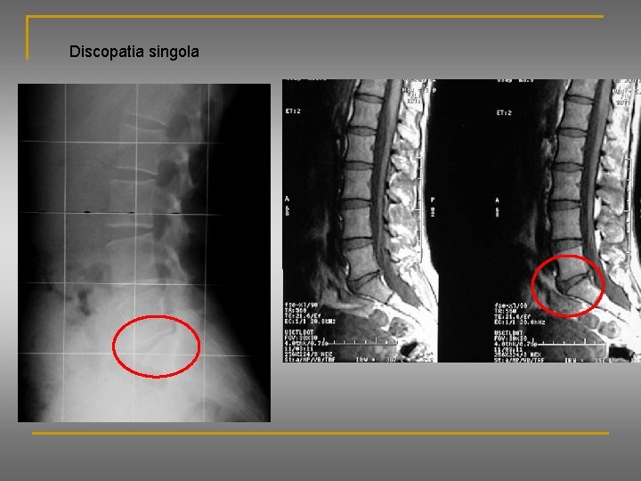 Discopatia singola 