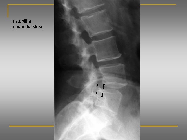 Instabilità (spondilolistesi) 