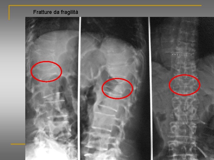 Fratture da fragilità 