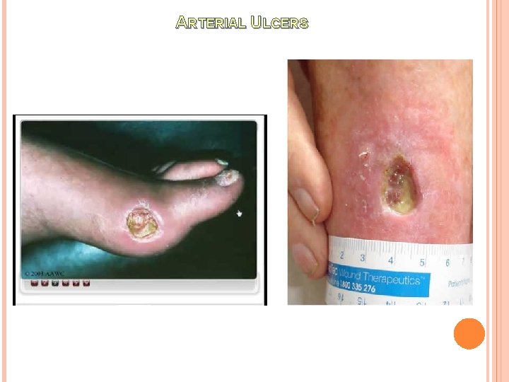 ARTERIAL ULCERS 