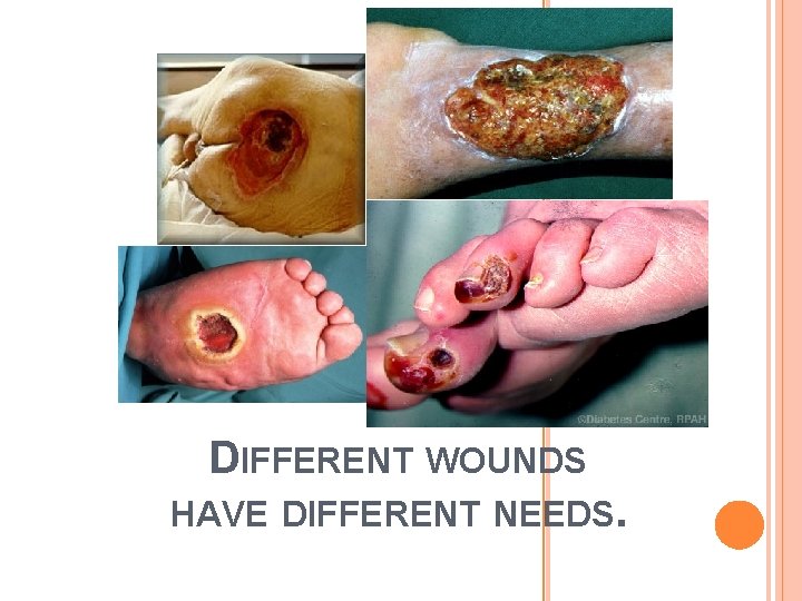 DIFFERENT WOUNDS HAVE DIFFERENT NEEDS. 