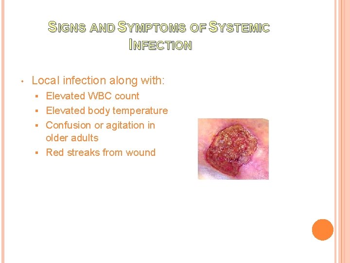 SIGNS AND SYMPTOMS OF SYSTEMIC INFECTION • Local infection along with: Elevated WBC count