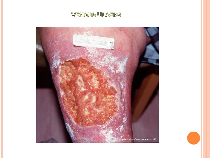 VENOUS ULCERS 
